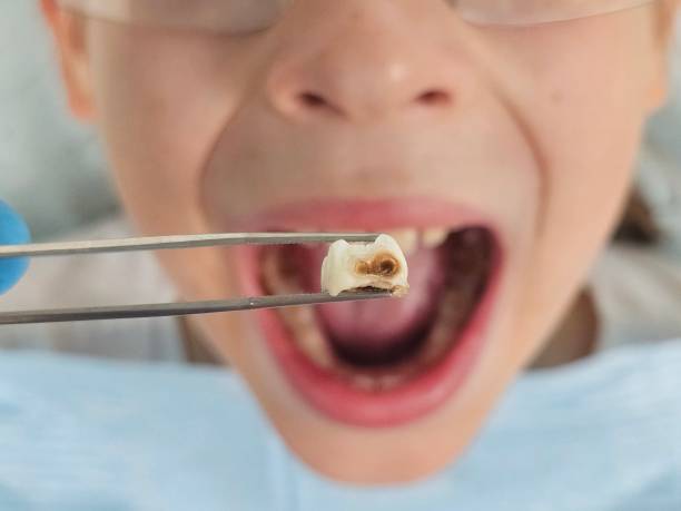 Best Emergency Tooth Extraction in Oak Harbor, WA